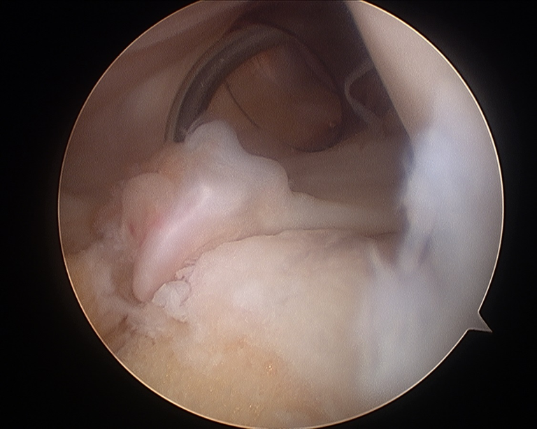 Meniscal Root Repair